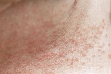 Heat Rash: Signs, Causes, Duration, and Treatment