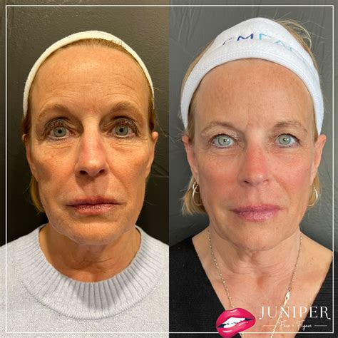 Ozempic Weight Loss + Body Changes - Juniper Face + Figure