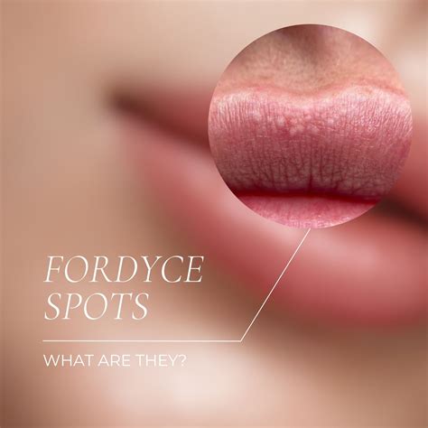 Fordyce spots, also known as Fordyce... - The Face Philosophy