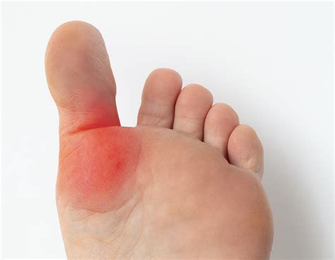 What is Hallux Rigidus? - Podiatry of Greater Cleveland