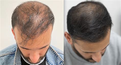 irfans laser hair growth treatment     este medical