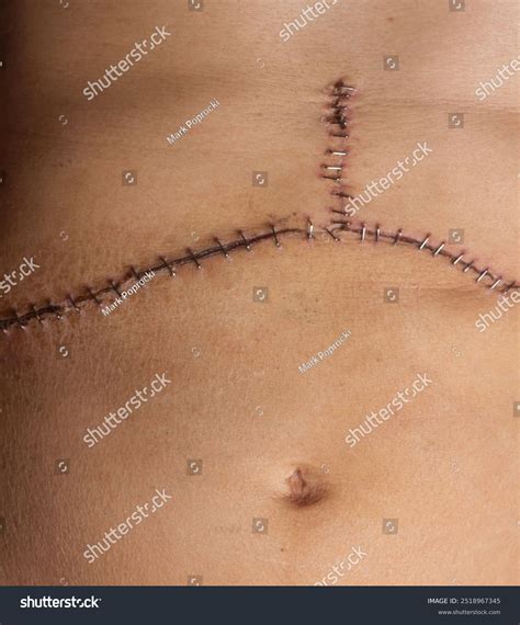 Closeup Medical Staples Helping Surgical Incision Stock Photo