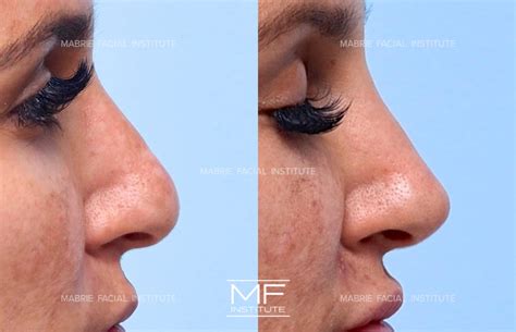 4 Ways To Make Your Nose Appear Smaller With Filler | Mabrie Facial