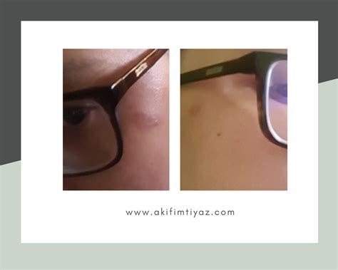 cara mengatasi kulit yang terkena minyak panas 4