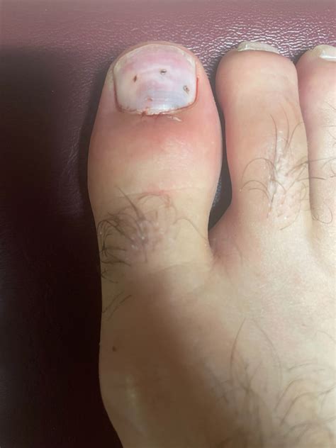 What Is A Nodule Under The Nail at Thomas Campion blog