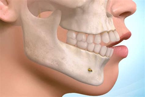 jaw surgery orthognathic definition side effects  benefits