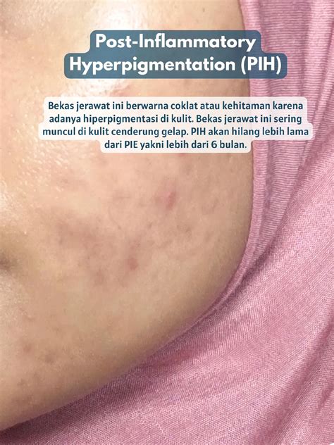 mengatasi bekas jerawat pih  pie galeri diposting oleh