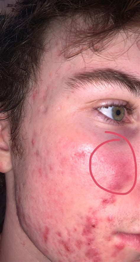 huge cyst  developed today     ive
