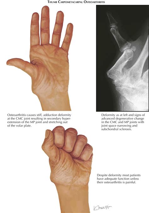 Hand and Finger - Clinical Tree