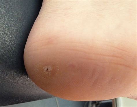 Plantar Wart On Heel - Plant Ideas