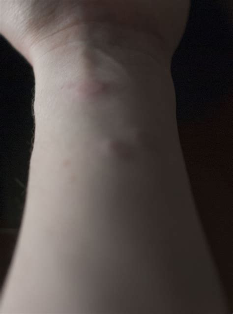 kind  rash   candida die