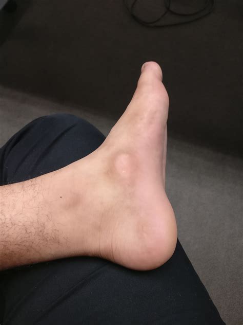 accessory navicular  image   foot showing localized erythema