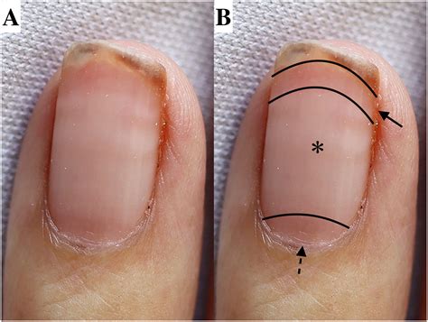Jaundice Fingernails