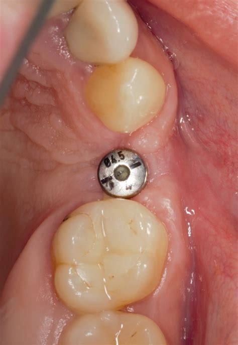 Простой. Надежный. Дешевый. Способ остеопластики. — IMPLANT-IN.COM ...