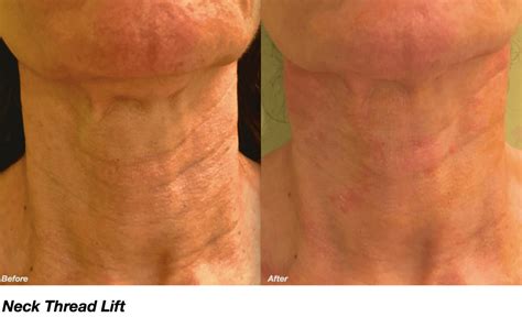 neck thread lift  vancouver dr mazanderani dr fazeli