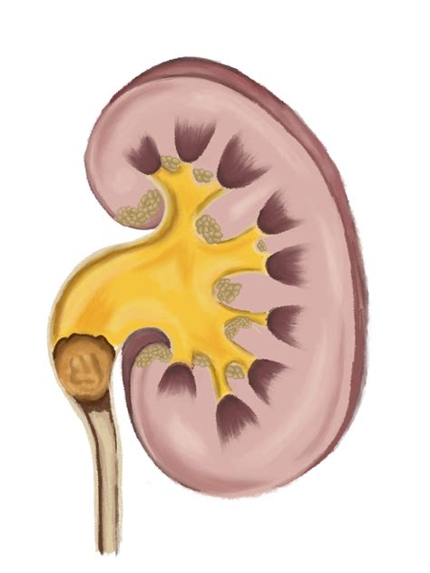 kidney stones hobart davies urology