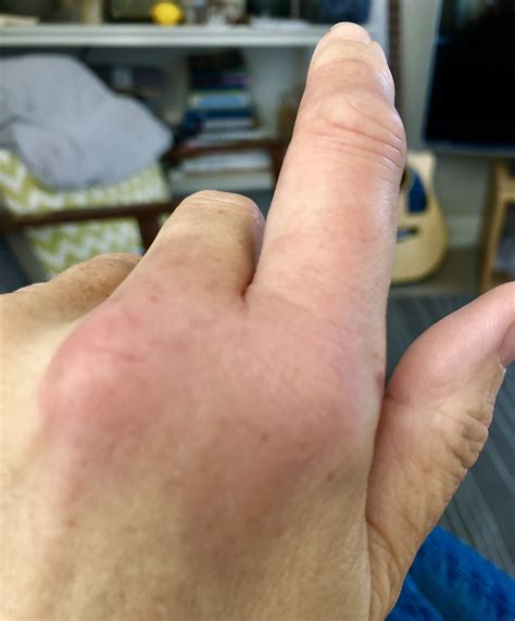 Wasp Sting On Finger Kadannal' Or Wasp Attack: Precautions, Remedies
