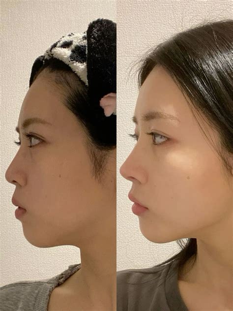 reduce puffy face swollen face  slim face  glowing skin full