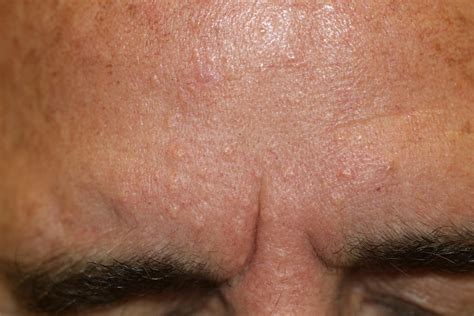 Clogged Oil Glands Face at Jasper Corral blog