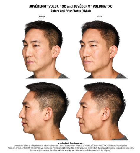 jawline contouring  juvederm volux xc  encino ca san