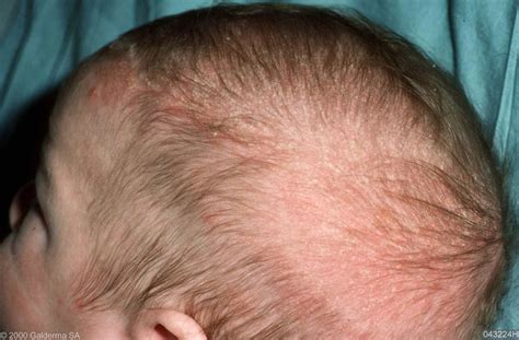 skin disease types seborrheic dermatitis vrogueco