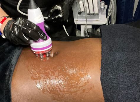 radio frequency skin tightening airdrie harmony sculpt