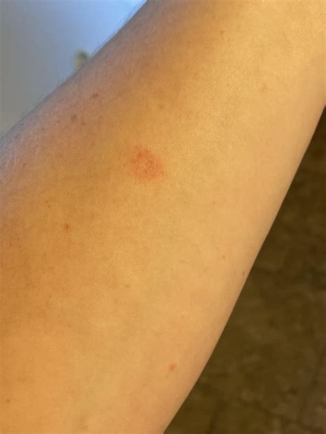 how to know if ringworm is getting better