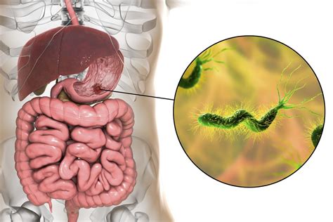 Chá Que Acabar Com A Bactéria H Pylori - Médico aponta chá anti-inflamatório que ajuda a combater a H. pylori