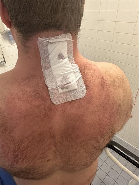 Cervical foraminotomy, worried about permanent nerve damage now : r