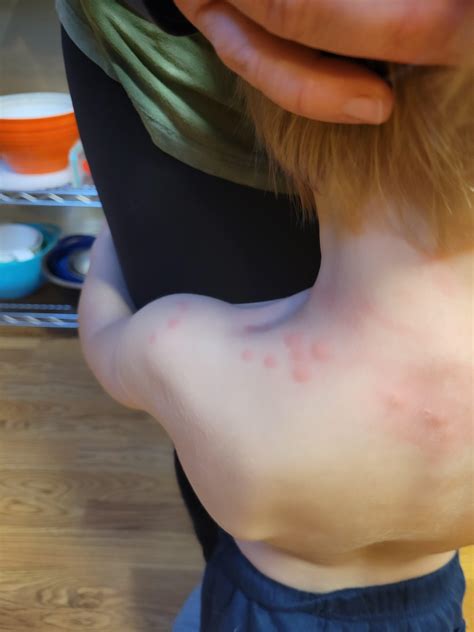 Early stage spider bite bruise signs will help you seek treatment 18