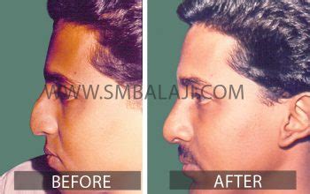 Best Rhinoplasty Surgeon in India, cost of rhinoplasty in india