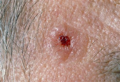 Rodent ulcer with typical rolled edge on temple - Stock Image - M131