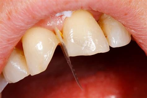 Tooth Fracture Classification