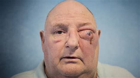 man discovers  tooth ache    life threatening flesh