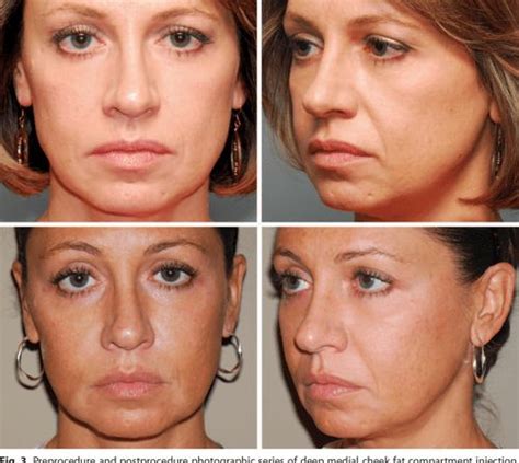 figure   anatomy  analysis  midface volumizing procedures