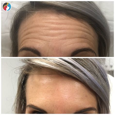 Botox Treatment | Syracuse, Albany, Rochester, New Hartford