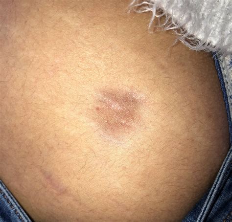 skin atrophy  steroid injection
