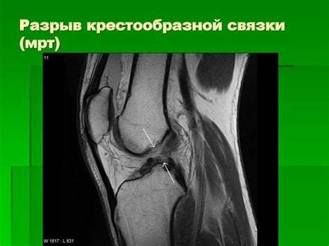 Повреждения коленного сустава - презентация онлайн
