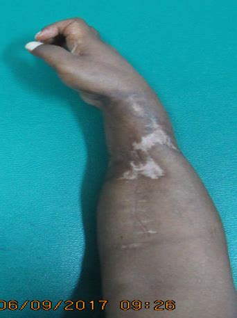 Trauma: Chronic Volkmann’s Contracture (48232) – CSC Staff Teaching and ...