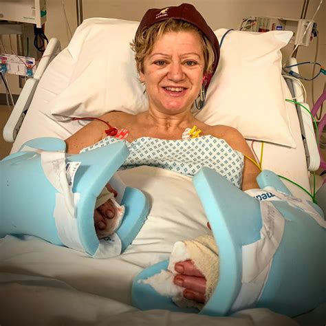 Scots mum - who had parts of all four limbs amputated to save life