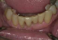 ; Lingual view of final esthetic result of the natural tooth pontic ...