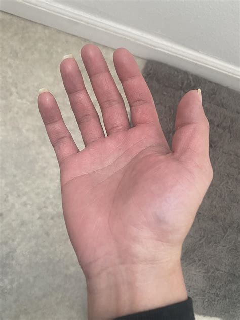 Are my fingers supposed to be straight or is this normal? Both hands