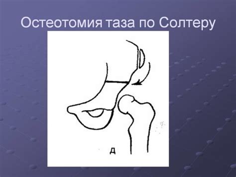 Остеотомия таза: показания, подготовка, виды и техника выполнения
