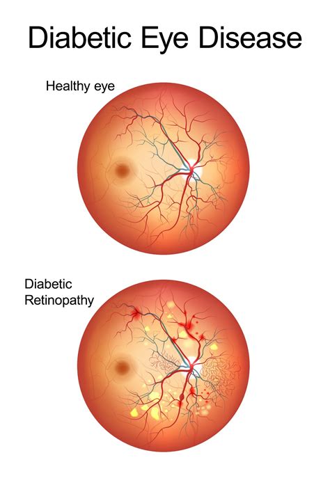 Nonproliferative Diabetic Retinopathy