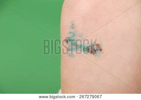 Scraped Knee Little Image & Photo (Free Trial) | Bigstock