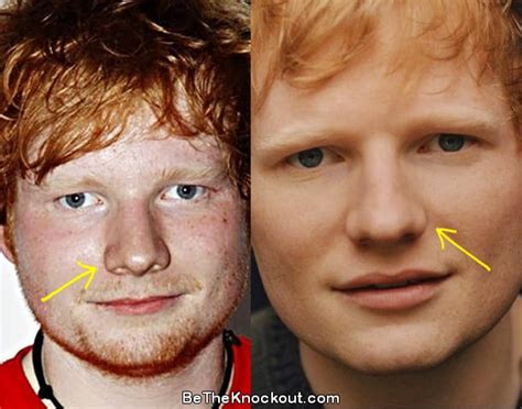 Ed Sheeran Plastic Surgery Comparison Photos