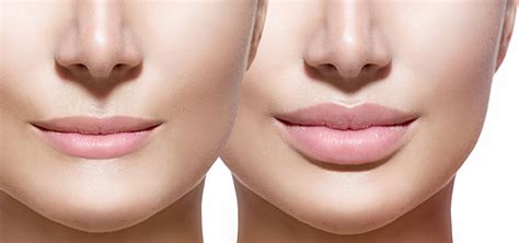 🥇 Atlanta GA Lip Filler Treatment | Buckhead Facial Plastic Surgeon