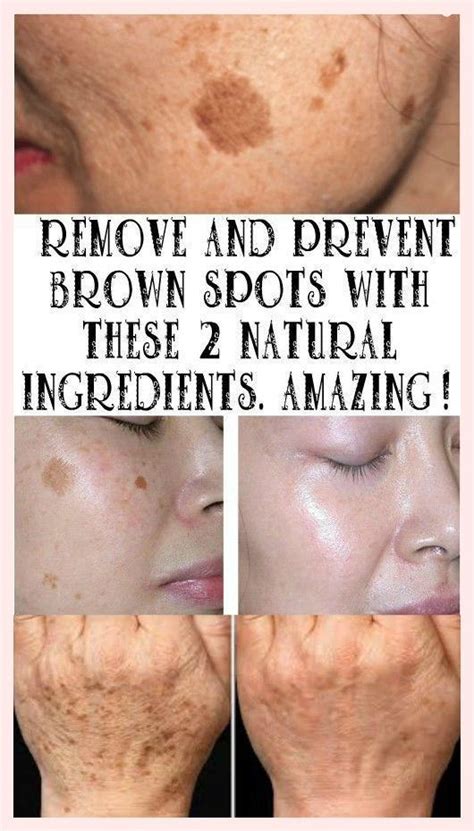 Brown spots on skin – Artofit