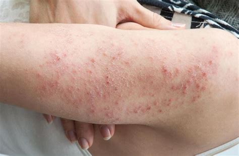 Understanding Diabetic Freckles: Causes Symptoms And Treatment | Justinboey