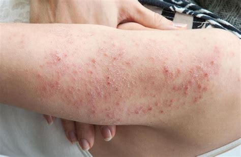 Diabetic rash pictures 1 | Symptoms and pictures